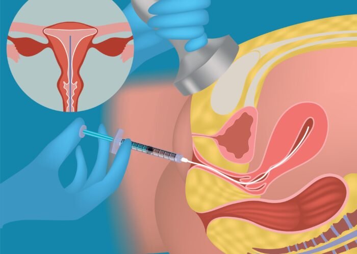 Der Embryotransfer-Prozess unter Ultraschallkontrolle beinhaltet das Einführen des Embryos in die Gebärmutter der Frau mit einem dünnen und flexiblen Katheter an der optimalsten Stelle in der Gebärmutter.
